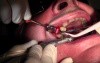 BSB Implant Placement #4 into Mineross Regenerated Bone