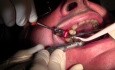 BSB Implant Placement #4 into Mineross Regenerated Bone