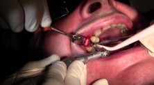 BSB Implant Placement #4 into Mineross Regenerated Bone