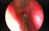 Large Choanal Polyp - Endoscopic Removal