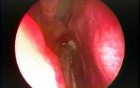 Large Choanal Polyp - Endoscopic Removal