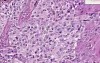 Malignant melanoma - Histopathology of skin