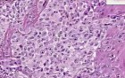 Malignant melanoma - Histopathology of skin