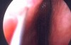 Septoplasty - Endoscopy