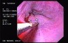 Hemorrhage due status post rubber band ligation of esophageal varices (13 of 25)