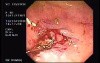 Tubulo - Villous Adenoma - Endoscopy (9 of 28)