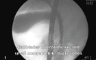 Pancreatitis- endooscopic treatment