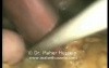 Nissen Fundoplication