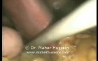 Nissen Fundoplication