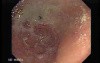 Adenocarcinoma of the Cardias - 91 Years-Old Male