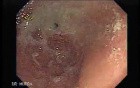 Adenocarcinoma of the Cardias - 91 Years-Old Male