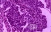 Gallbladder Adenocarcinoma and litiasis (7 of 13)