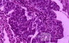 Gallbladder Adenocarcinoma and litiasis (7 of 13)