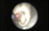 Ureteroscopic Laser Lithotripsy