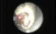 Ureteroscopic Laser Lithotripsy