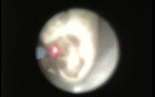 Ureteroscopic Laser Lithotripsy