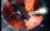 Gastrointestinal Stromal Tumor - GIST (27 of 65)