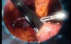 Gastrointestinal Stromal Tumor - GIST (27 of 65)
