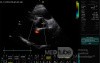 Ostium Secundum Atrial Septal Defect (ASD)