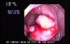 Ulcerated Annular Adenocarcinoma