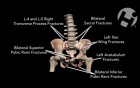 Pelvic Injuries