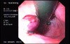 Banding of Esophageal Varices - Presence of Four Banded Varices