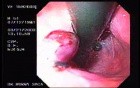 Banding of Esophageal Varices - Presence of Four Banded Varices