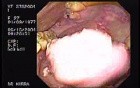 Oropharynge Candidiasis 27-year-old female HIV-positive patient (4 of 5)