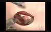 Femoral Acetabular Impingement - 3D Medical Animation