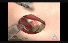 Femoral Acetabular Impingement - 3D Medical Animation