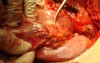 Diffuse Adenocarcinoma with signet ring cells (6 of 18)