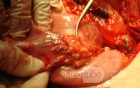 Diffuse Adenocarcinoma with signet ring cells (6 of 18)