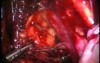 Excision of Lymph Nodes by Use of Laparoscopy