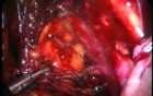 Excision of Lymph Nodes by Use of Laparoscopy