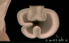 Transoral Gastroplasty (TOGA)