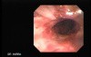 Traqueostomy Fistula (1 of 5)