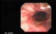 Traqueostomy Fistula (1 of 5)