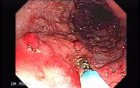 Colitis Ulcerosa - Pseudopolyps (14 of 22)