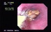 Polypectomy Snare in Non-typical Usage - Foreign Body Retrieval
