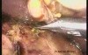 Two-Port Laparoscopic Cholecystectomy