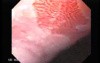 Barrett's Esophagus of long segment (8 of 24)