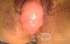 uterino vaginal prolapse