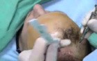 Hair Transplantation - implanter instrument adjustment