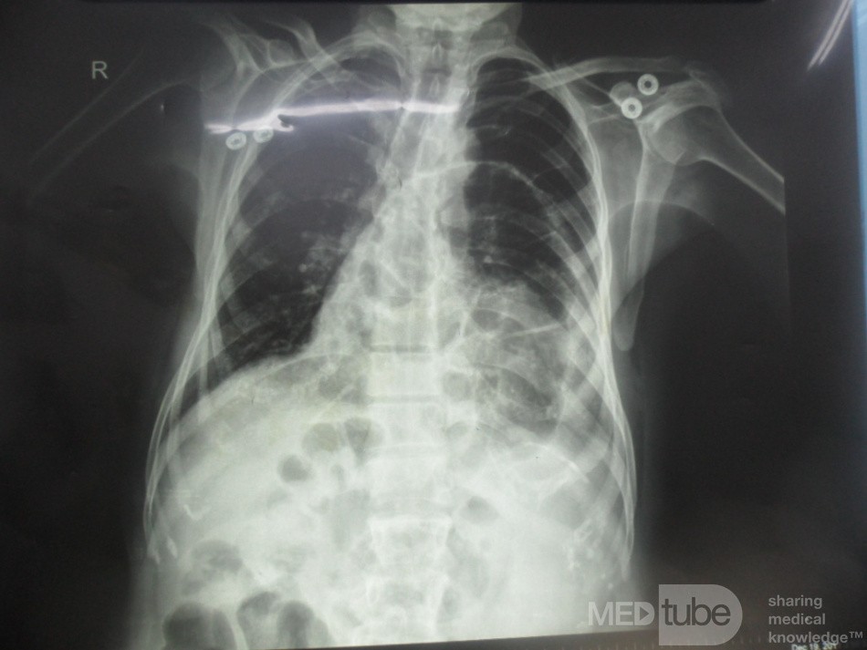 Diaphragmatic Hernia 