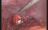 Bilateral Inguinal Hernia Repair With Surgisis Mesh