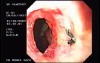 Zollinger- Ellison Syndrome - Gastric Ulcer with Gastrocolic Fistula (19 of 21)