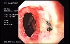 Zollinger- Ellison Syndrome - Gastric Ulcer with Gastrocolic Fistula (19 of 21)
