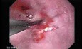 Endoscopic Baloon Dilation Of The Esophageal Stricture - Overcoming The Stricture