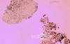 Non-Hodking Lymphoma B Cells. MALT (mucosa associated lymphoid tissue) (4 of 7)