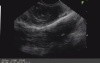 Esophageal leiomyoma
